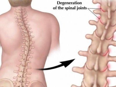 Low Back Pain, Ancaman Serius Bagi Kualitas Hidup Sehari-Hari