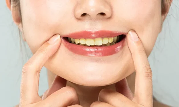 Kenali Kebiasaan Harian Yang Membuat Warna Gigi Menguning